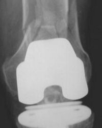Periprosthetic Fracture After Total Knee Replacement